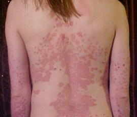 Psoriasis_on_back1